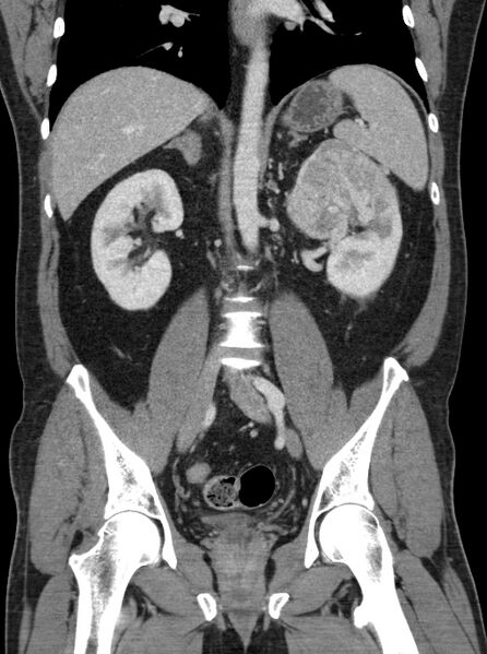 File:Clear cell renal cell carcinoma (Radiopaedia 61449-69393 F 26).jpg