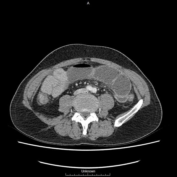 File:Closed loop bowel obstruction and ischemia (Radiopaedia 86959-103180 A 50).jpg