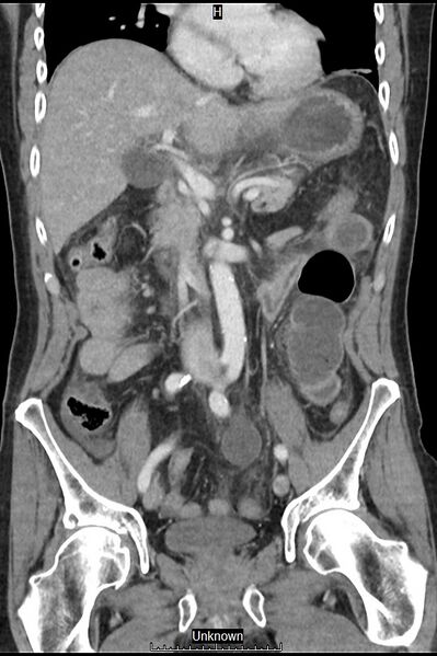 File:Closed loop bowel obstruction and ischemia (Radiopaedia 86959-103180 B 19).jpg