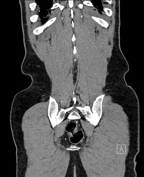 File:Closed loop small bowel obstruction - internal hernia (Radiopaedia 57806-64778 A 108).jpg
