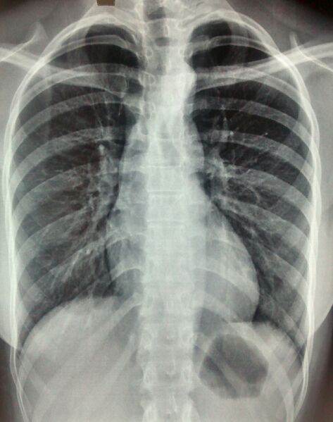 File:Coarctation of aorta (Radiopaedia 36672).jpg