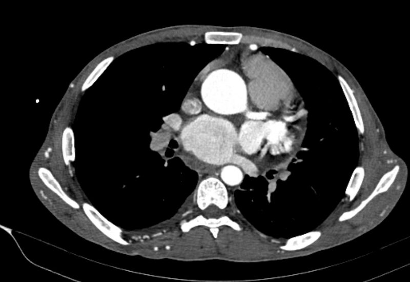 File:Coarctation of aorta with aortic valve stenosis (Radiopaedia 70463-80574 A 100).jpg