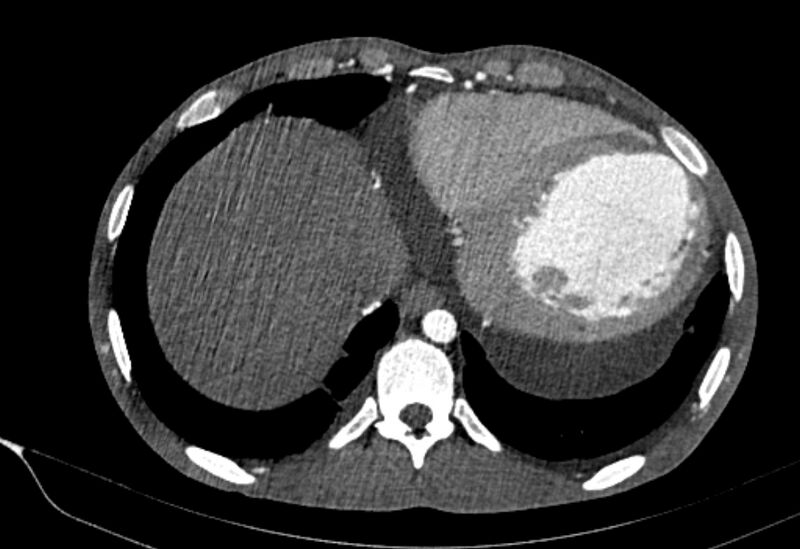 File:Coarctation of aorta with aortic valve stenosis (Radiopaedia 70463-80574 A 191).jpg