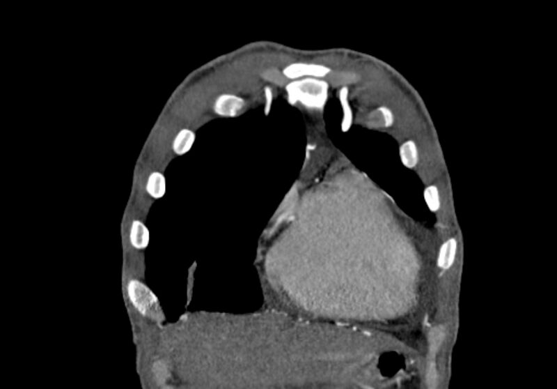 File:Coarctation of aorta with aortic valve stenosis (Radiopaedia 70463-80574 C 16).jpg