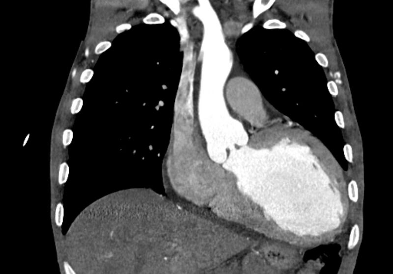 File:Coarctation of aorta with aortic valve stenosis (Radiopaedia 70463-80574 C 81).jpg