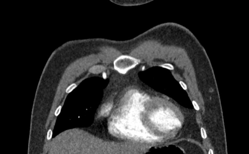 File:Coarctation of the aorta (Radiopaedia 53363-59343 C 11).jpg