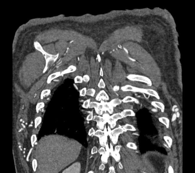 File:Coarctation of the aorta (Radiopaedia 53752-59822 B 74).jpg