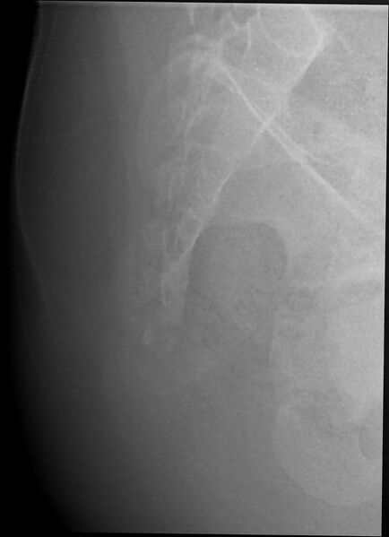 File:Coccyx fracture (Radiopaedia 68051-77520 Lateral 1).jpg