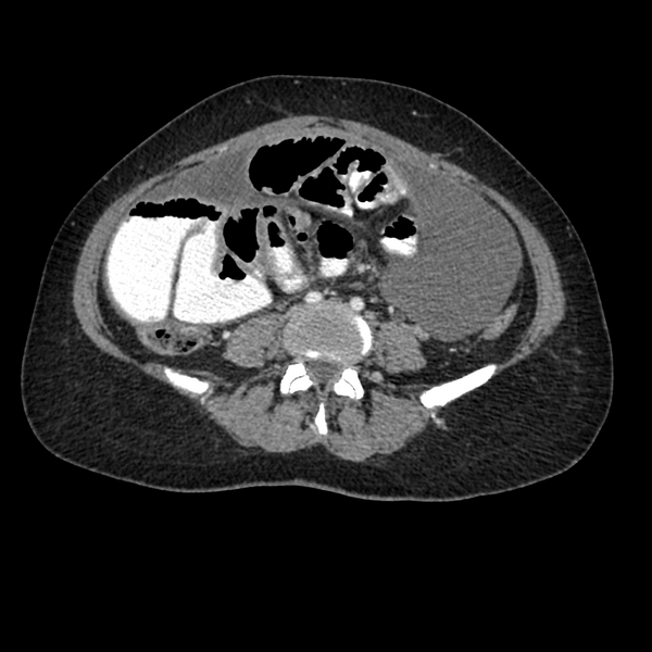 File:Cocoon abdomen with possible tubo-ovarian abscess (Radiopaedia 46235-50636 A 27).png