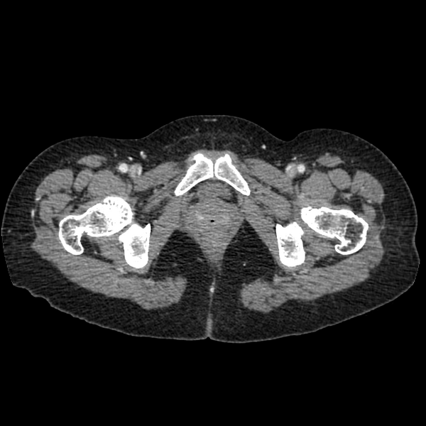 File:Cocoon abdomen with possible tubo-ovarian abscess (Radiopaedia 46235-50636 A 44).png