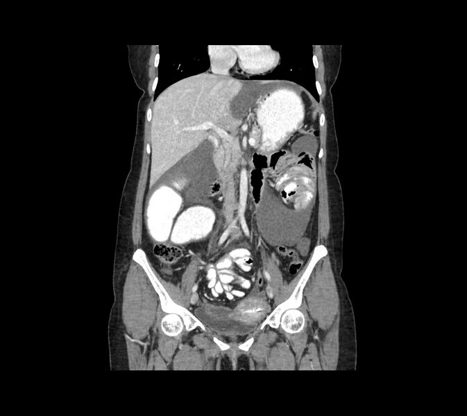 File:Cocoon abdomen with possible tubo-ovarian abscess (Radiopaedia 46235-50636 B 25).jpg