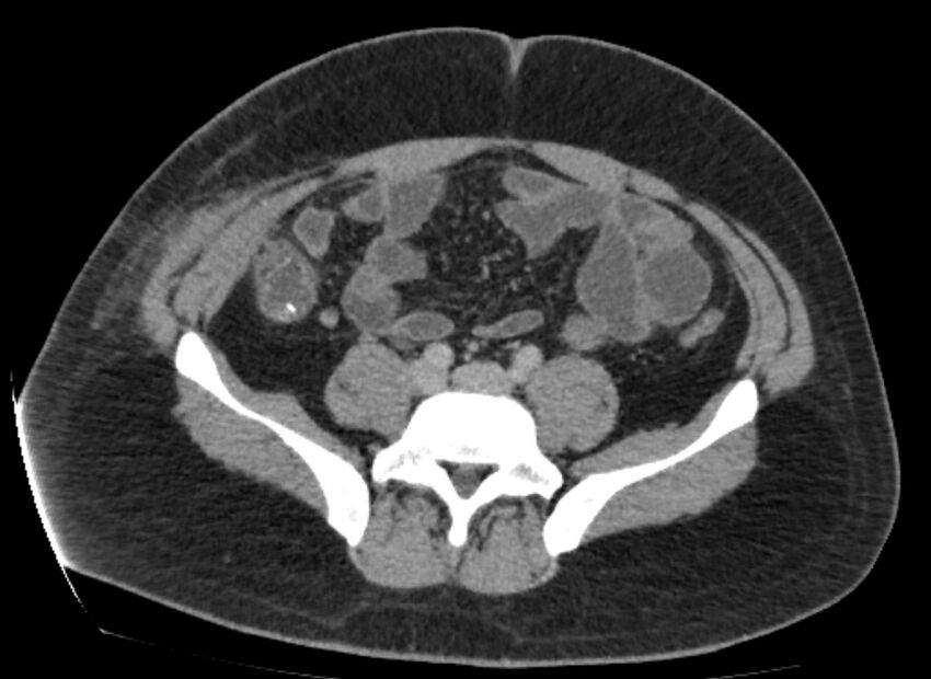 Colocutaneous fistula (Radiopaedia 56401-63062 A 62).jpg