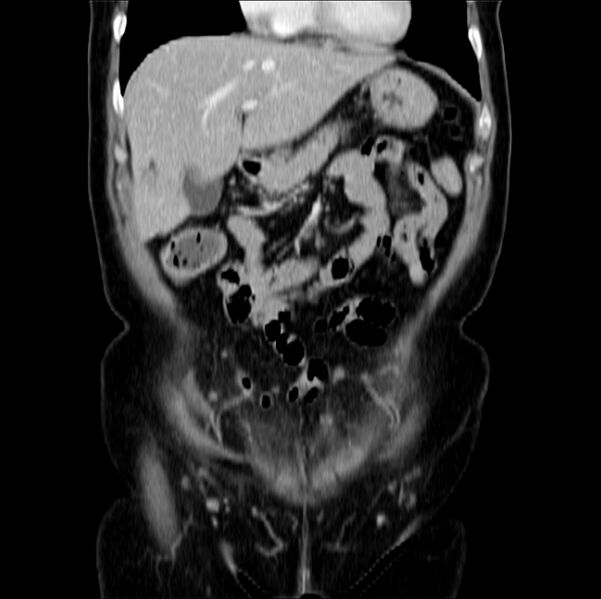 File:Colon carcinoma with hepatic metastases (Radiopaedia 29477-29961 B 14).jpg