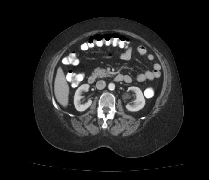 File:Colonic diverticulosis (Radiopaedia 22934-22957 A 30).jpg