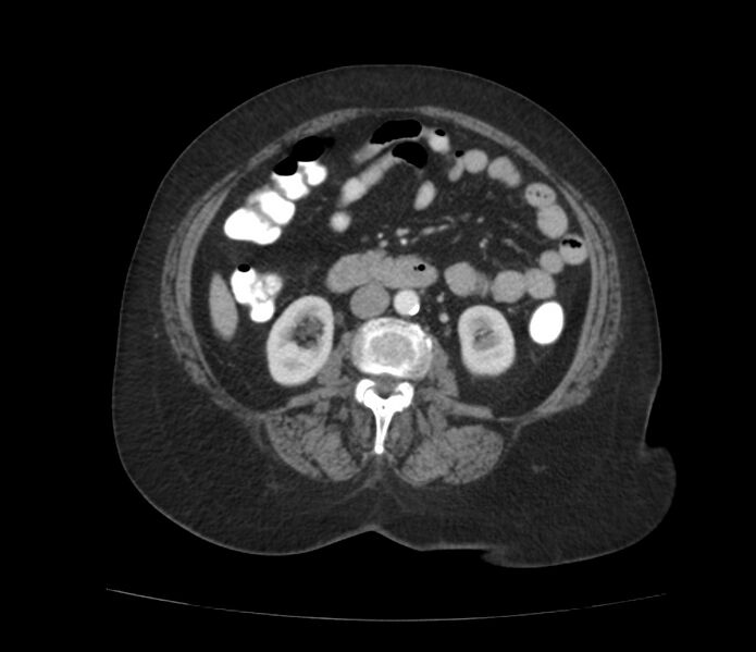 File:Colonic diverticulosis (Radiopaedia 22934-22957 A 34).jpg