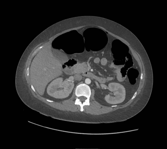 File:Colonic pseudo-obstruction (Radiopaedia 79752-92980 A 71).png