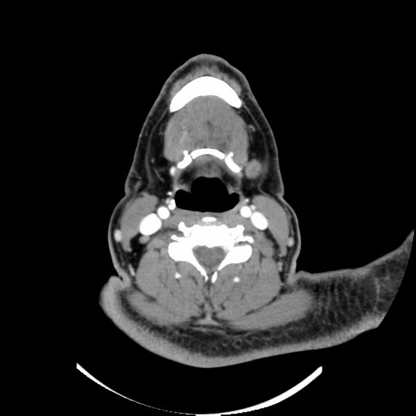 File:Hat in the neck (Rorschach radiology) (Radiopaedia 49023).jpg
