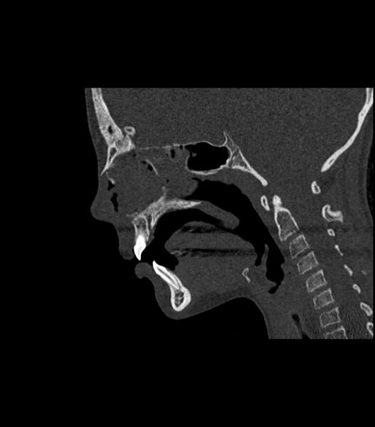 File:Nasoorbitoethmoid fracture (Radiopaedia 90044-107205 Sagittal bone window 76).jpg