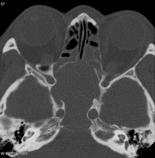 File:Nasopharyngeal carcinoma (recurrent) (Radiopaedia 5061-6903 Axial non-contrast 12).jpg