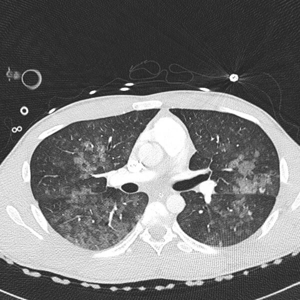 File:Near drowning (pulmonary edema) (Radiopaedia 24685-24958 lung window 22).jpg