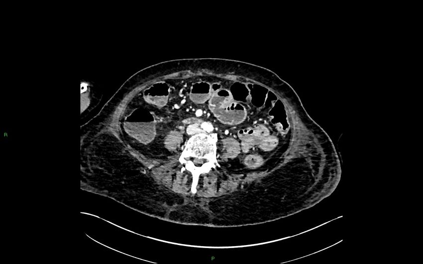 Neo-terminal ileal stricture (Crohn disease) (Radiopaedia 33790-34948 A 262).jpg