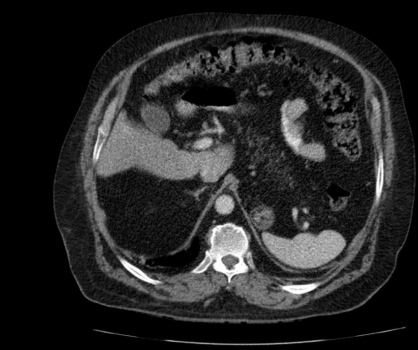 Nephroptosis with inguinal hernia containing perirenal fat (Radiopaedia 56632-63391 C 97).jpg