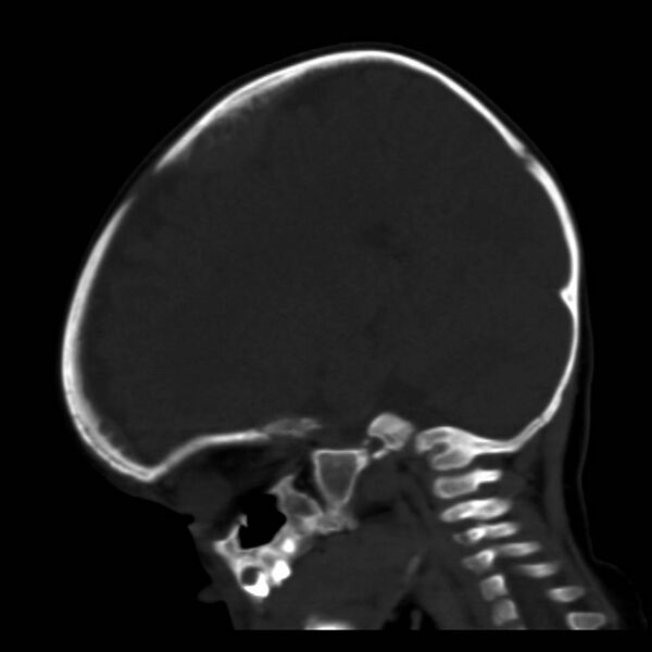 File:Neuroblastoma with skull metastases (Radiopaedia 30326-30958 Sagittal bone window 16).jpg