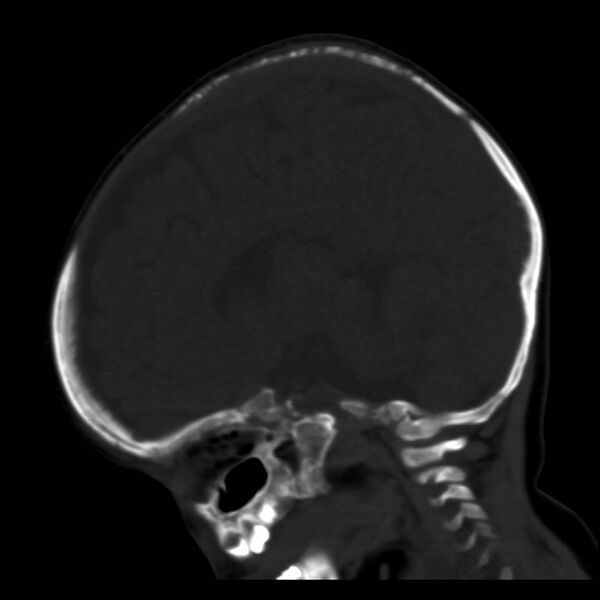 File:Neuroblastoma with skull metastases (Radiopaedia 30326-30958 Sagittal bone window 24).jpg
