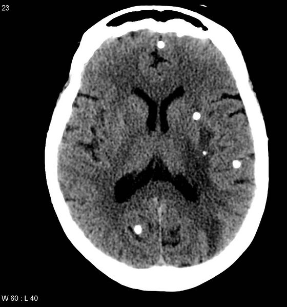 File:Neurocysticercosis (Radiopaedia 7773-8596 non-contrast 7).jpg