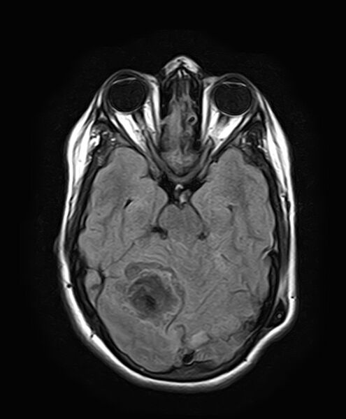 File:Neurofibromatosis type 2 (Radiopaedia 66211-75401 Axial FLAIR 13).jpg