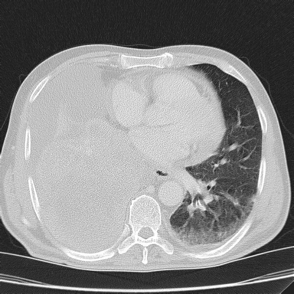 File:Non small-cell lung cancer (Radiopaedia 24467-24769 lung window 32).jpg