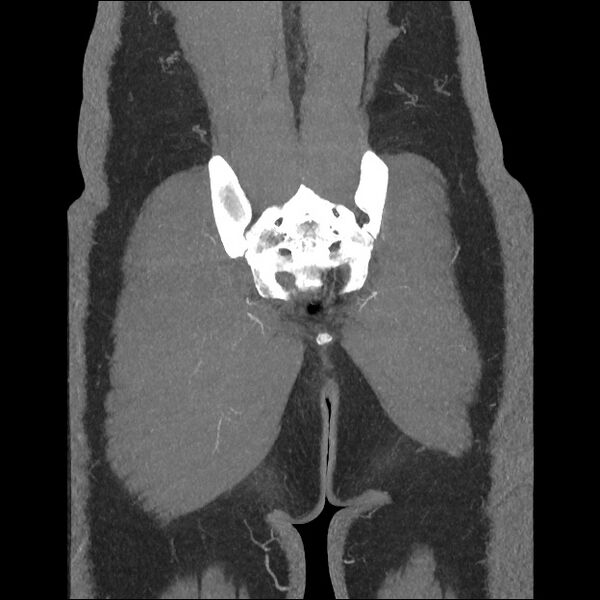 File:Normal CT angiogram of pelvis (Radiopaedia 45390-49430 B 41).jpg
