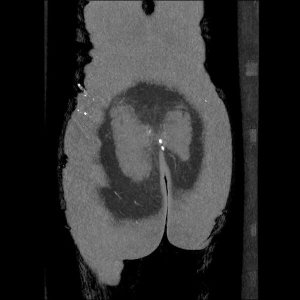 File:Normal CT angiogram of pelvis (Radiopaedia 45390-49430 B 46).jpg
