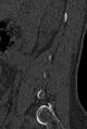 Normal CT lumbar spine (Radiopaedia 53981-60118 Sagittal bone window 9).jpg