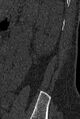 Normal CT lumbar spine (Radiopaedia 53981-60118 Sagittal bone window 98).jpg