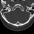 Normal CT of the cervical spine (Radiopaedia 53322-59305 Axial bone window 22).jpg