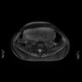 Normal MRI abdomen in pregnancy (Radiopaedia 88001-104541 D 37).jpg
