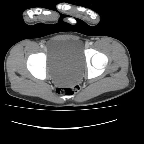 File:Normal dual-phase trauma CT chest,abdomen and pelvis (Radiopaedia 48092-52899 A 107).jpg