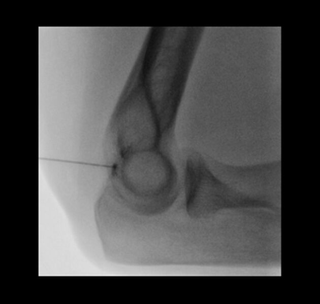 File:Normal elbow arthrograms (Radiopaedia 75550-86945 Lateral 5).jpg