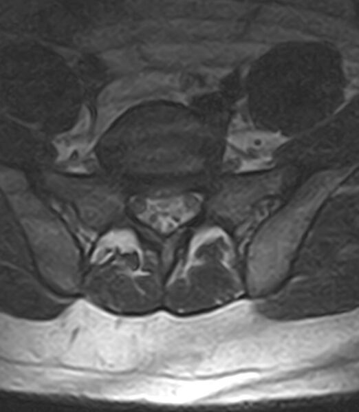 File:Normal lumbar spine MRI - low-field MRI scanner (Radiopaedia 40976-43699 Axial T2 89).jpg