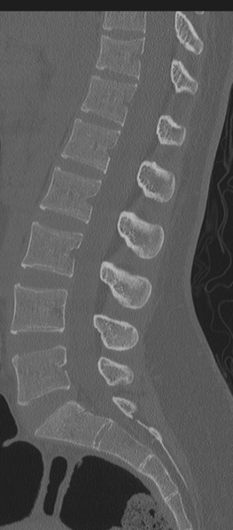 File:Normal lumbosacral CT (Radiopaedia 37923-39867 Sagittal bone window 49).png