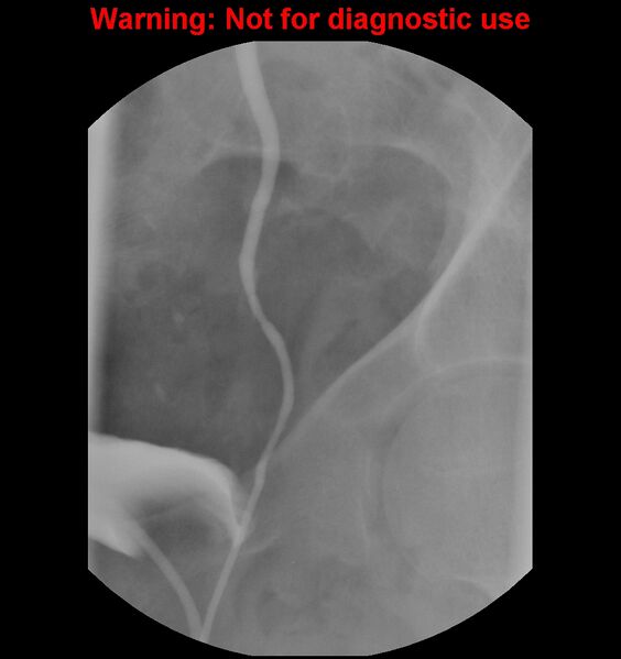 File:Normal retrograde pyelography of a native and transplant kidney (Radiopaedia 40480-43054 Native kidney 22).jpg