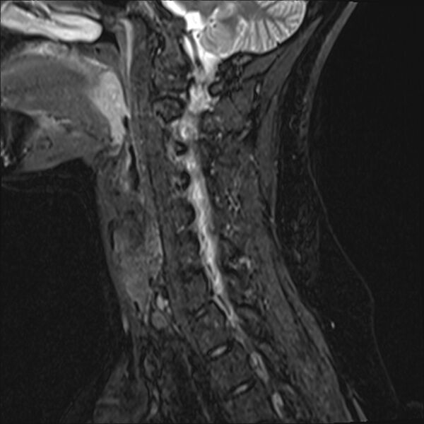 File:Normal trauma cervical spine MRI (Radiopaedia 32130-33071 Sagittal STIR 11).jpg