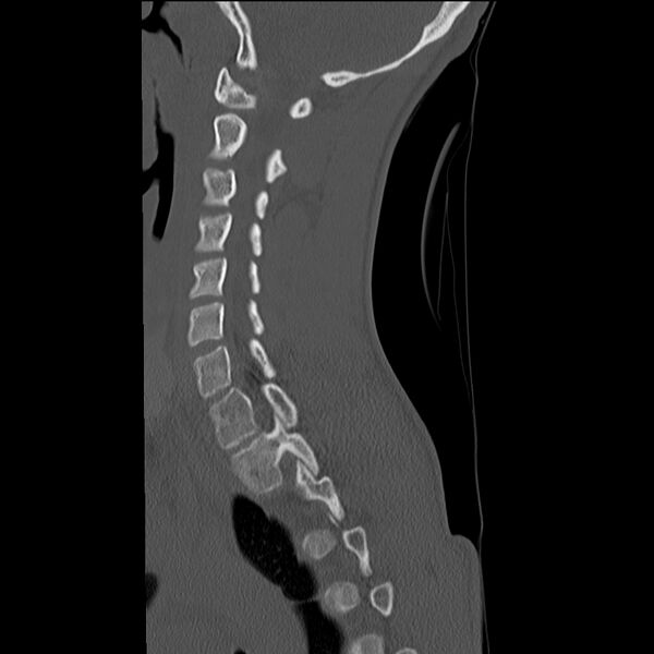 File:Normal trauma spine imaging (age 16) (Radiopaedia 45335-49358 Sagittal bone window 25).jpg