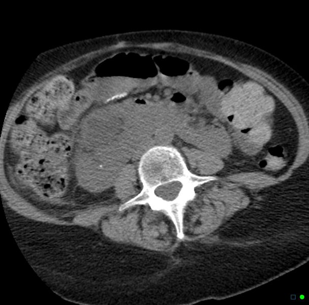 File:Obstructed infected horseshoe kidney (Radiopaedia 18116-17898 non-contrast 18).jpg