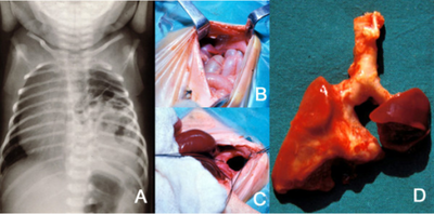 a)Posterolateral diaphragmatic hernia was discovered b) small bowel loops entering the thorax c) after reducing contents d)extreme left lung hypoplasia