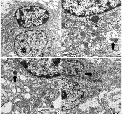 a-d)Ultrastructural findings of dysembryoplastic neuroepithelial tumors