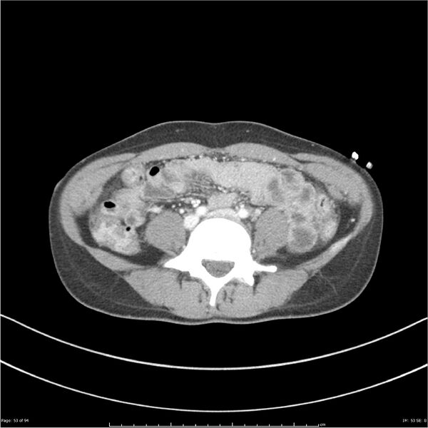 File:Traumatic renal artery dissection and pancreatic transection (Radiopaedia 37061-38739 Axial 216).jpg