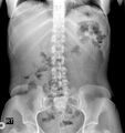 11 pairs of ribs and lumbosacral transitional vertebra (Radiopaedia 61880-69918 C 1).jpg