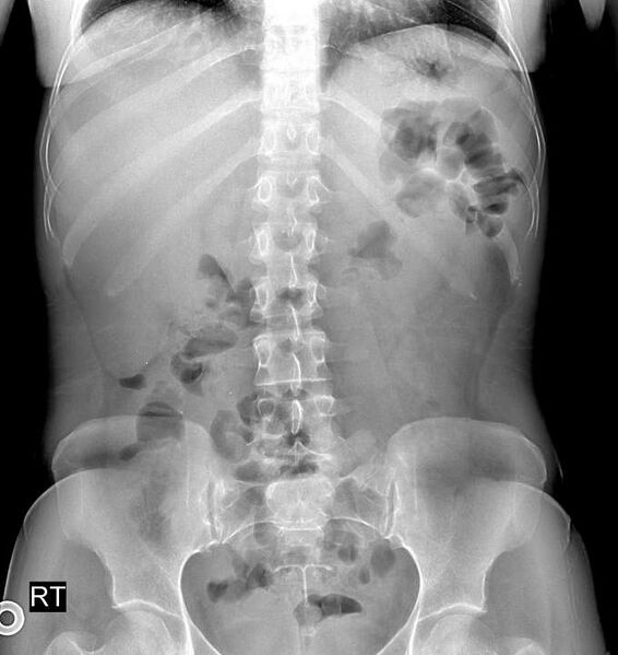 File:11 pairs of ribs and lumbosacral transitional vertebra (Radiopaedia 61880-69918 C 1).jpg